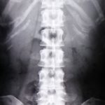 腰椎のレントゲン写真。恵比寿コ・メディカル整体院