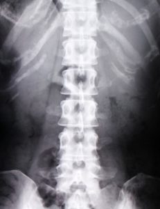 腰椎のレントゲン写真。恵比寿コ・メディカル整体院